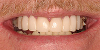 Closeup of smile before teeth whitening
