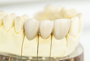 Model smile with fixed bridge restoration