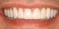 Closeup smile after whitening and tooth gap correction
