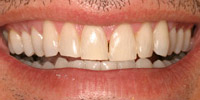 Closeup smile before whitening and tooth gap correction