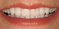 Woman's smile closeup after veneers