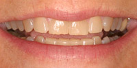 Woman's smile closeup before veneers