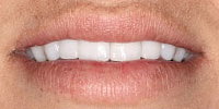 Young woman's smile closeup after cosmetic treatment