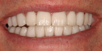 Closeup of older man's smile after cosmetic treatment