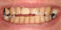 Closeup of older man's smile before cosmetic treatment