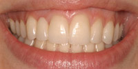Closeup of woman's smile after cosmetic dental care