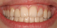 Closeup of woman's smile before cosmetic dental care