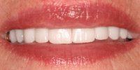 Closeup of older woman's smile after porcelain veneers