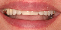 Closeup of older woman's smile before porcelain veneers