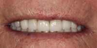 Front view of smile after smile makeover treatment