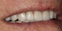 Left side view of smile after smile makeover treatment