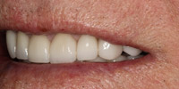 Left side view of smile after smile makeover treatment