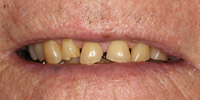 Front view of smile before smile makeover treatment