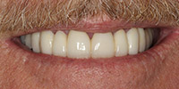 Closeup of smile after teeth whitening