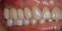 Right side view of smile after treatment