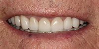 Front side view of smile after cosmetic treatment