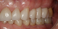 Left side view of smile after cosmetic treatment