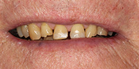 Front side view of smile before cosmetic treatment