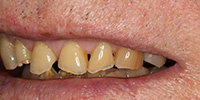 Left side view of smile before cosmetic treatment