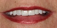 After receiving Bite correction & Veneers from Dr. Canzoneri