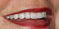 Right side view of smile after veneer treatment