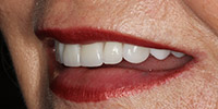 Left side view of smile after veneertreatment