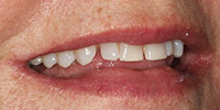 Right side view of smile before veneer treatment