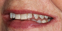 Left side view of smile before veneer treatment