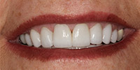 After receiving Porcelain Veneers in Arcadia