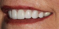 Left side view of smile after treatment