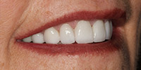 Right side view of smile after treatment