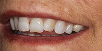 Left side view of smile before treatment