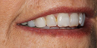 Right side view of smile before treatment