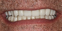 Right side view of smile after treatment