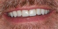 Left side view of smile after treatment