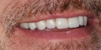 Right side view of smile after treatment