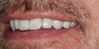 Right side view of smile after treatment