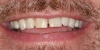 Left side view of smile before treatment