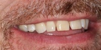 Right side view of smile before treatment