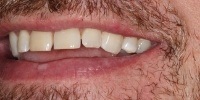Right side view of smile before treatment