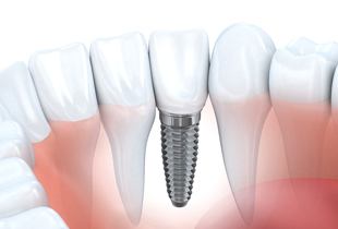 A diagram of a dental implant.