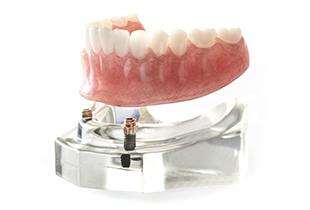 Model of implant supported denture