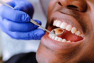 Closeup of smile during dental exam