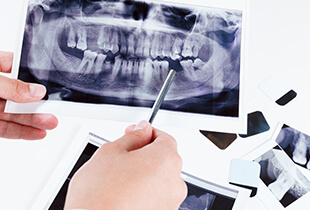 Hand pointing to dental x-rays