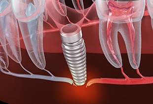A 3D illustration of a failed dental implant