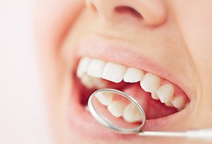 Closeup of patient with tooth-colored fillings in Arcadia