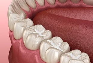Closeup of tooth-colored fillings in Arcadia on digital illustration 
