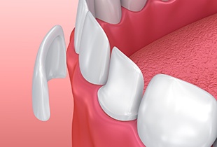 Animation of porcelain veneer placement