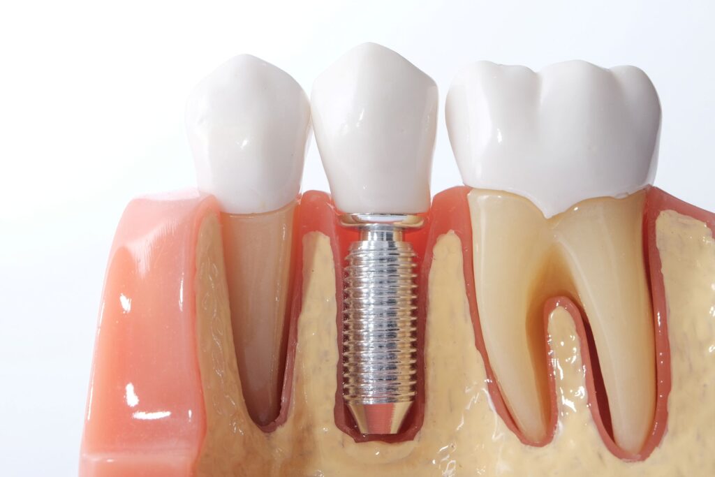 Model dental implant with white background