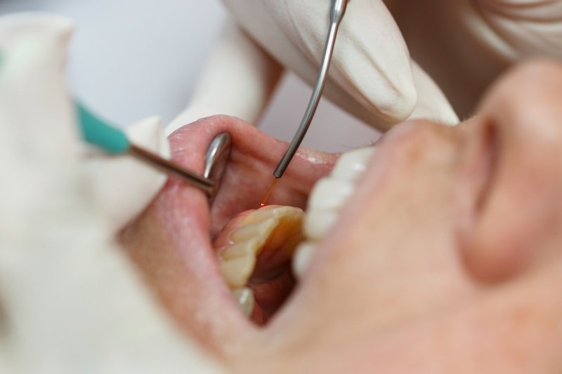  closeup of soft tissue laser dentistry in Arcadia